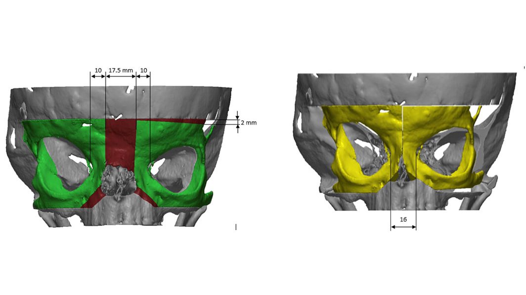 Figura 5: Risultato della simulazione (a) delle osteotomie e (b) del riposizionamento ottimale per minimizzare le asimmetrie